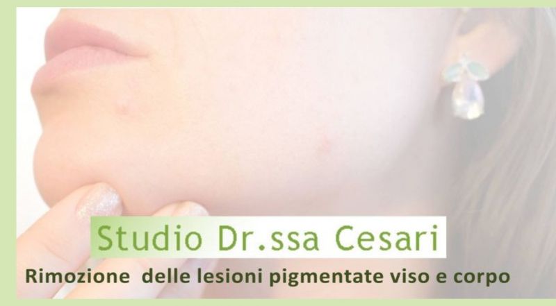  offerta trattamenti rimozione macchie della pelle a udine - promozione trattamenti laser pelle