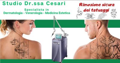  offerta studio specializzato nella rimozione sicura con laser dei tatuaggi