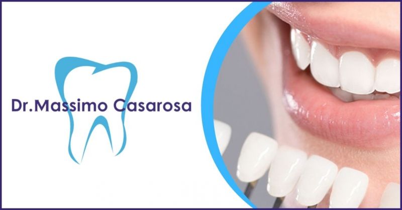 offerta faccette dentali per mascherare difetti dei denti – Studio Dentistico a Lucca e Versilia