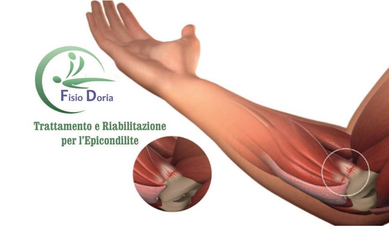  offerta terapia riabilitativa per l'epicondilite gomito del tennista