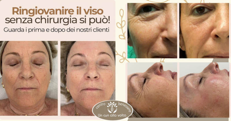 Ringiovanire il viso senza chirurgia