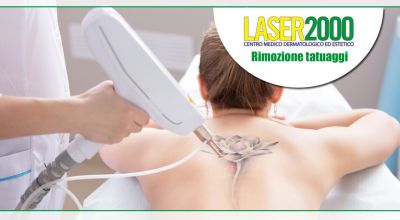 offerta rimozione tatuaggi a cosenza promozione rimozione tatuaggio con laser q switch cosenza