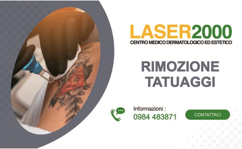 offerta laser per rimozione definitiva dei tatuaggi