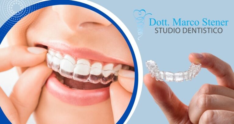 ortodonzia invisibile Studio dentistico Stener